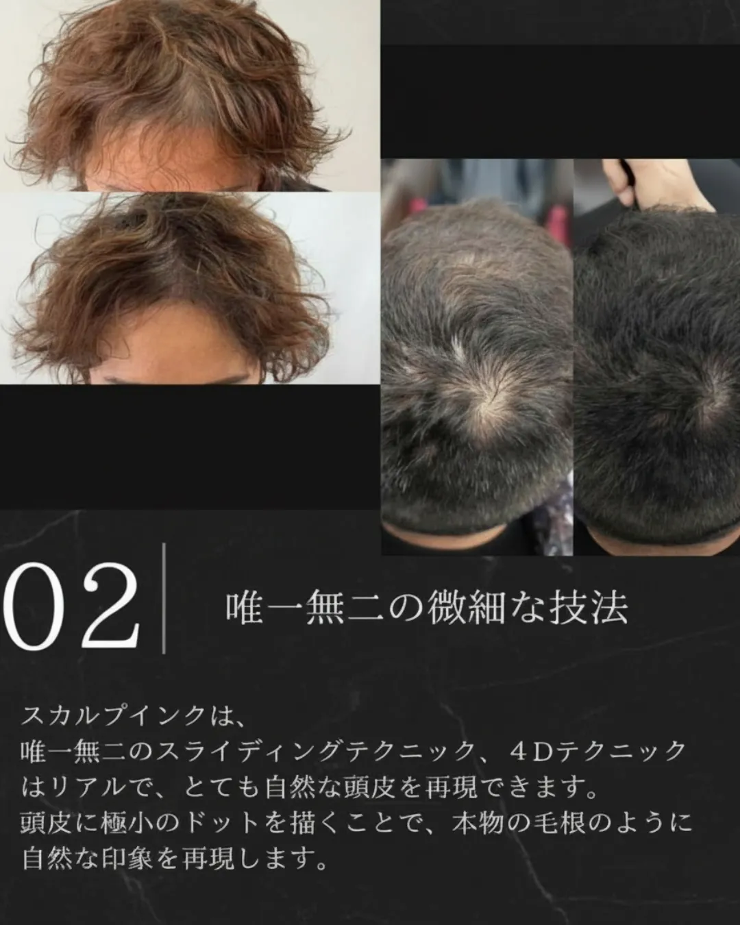 スカルプインクが選ばれる理由2|唯一無二の微細な技法で自然な毛根を再現した薄毛の症例