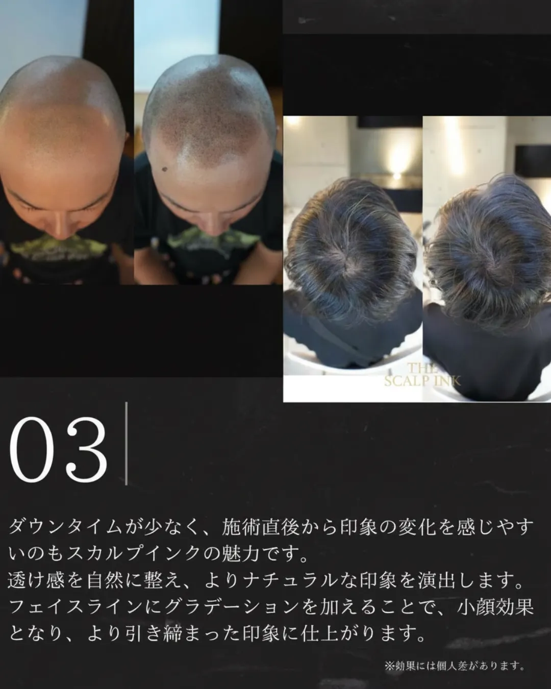 スカルプインクが選ばれる理由3|ダウンタイムが少なく施術直後から自然な仕上がりの症例