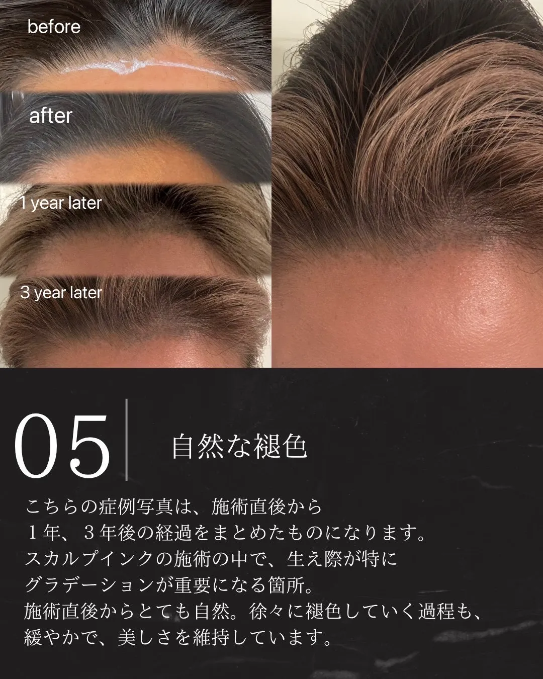 スカルプインクが選ばれる理由5|1年・3年後も自然に褪色する経過の症例