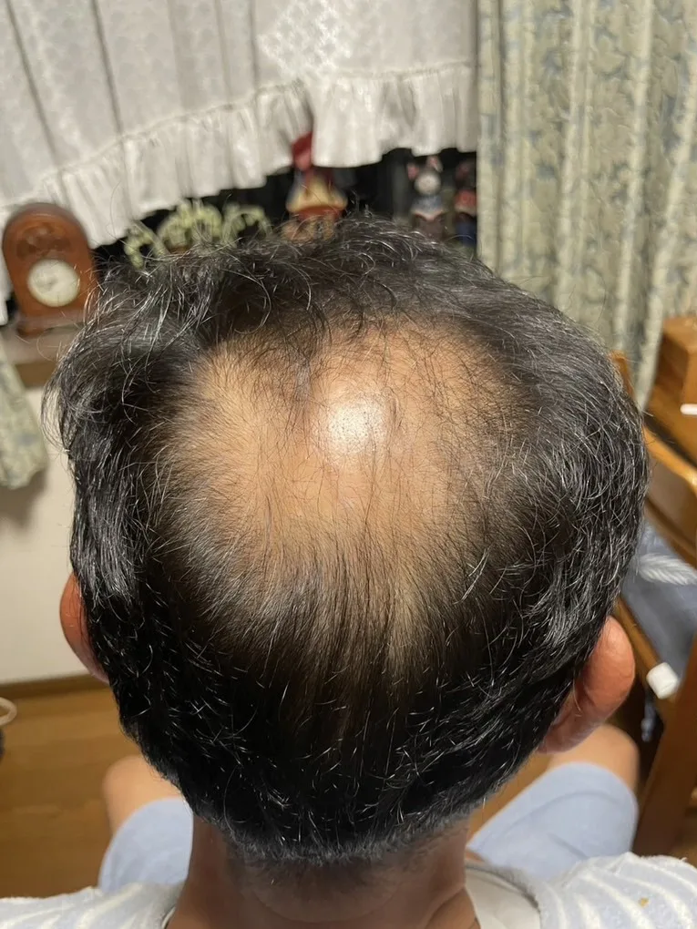 スカルプインク 男性/つむじ・頭頂部の地肌 ビフォー