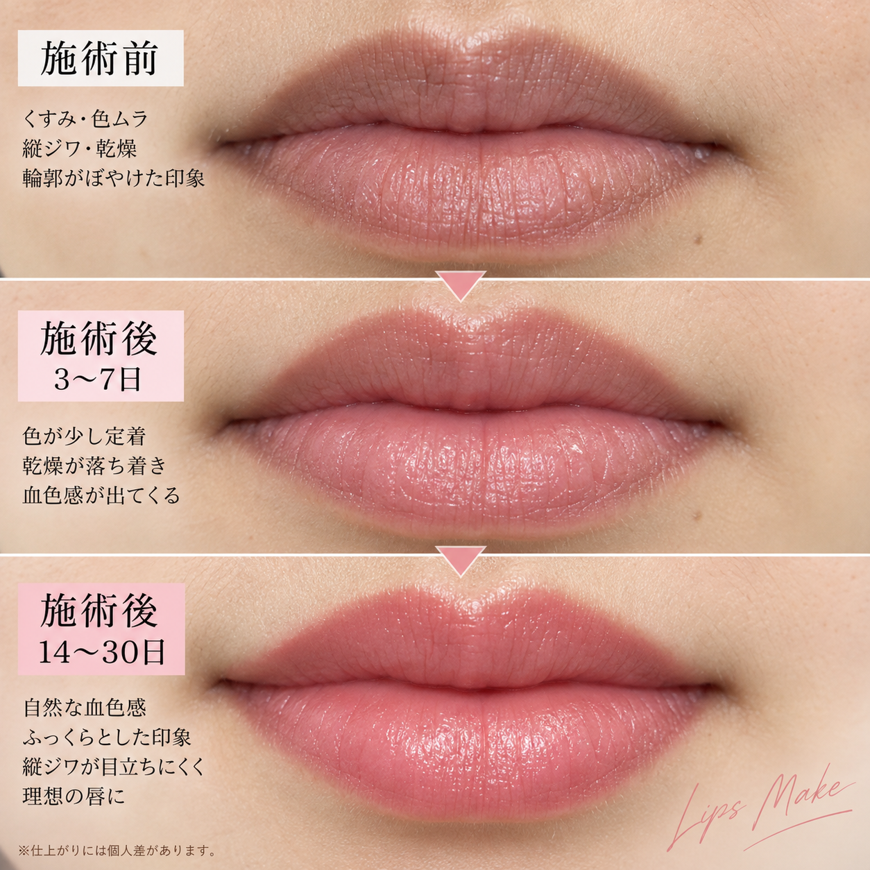 小牧市のローマピンク｜黒ずみ・色素沈着ケア Beauty Salon Lily